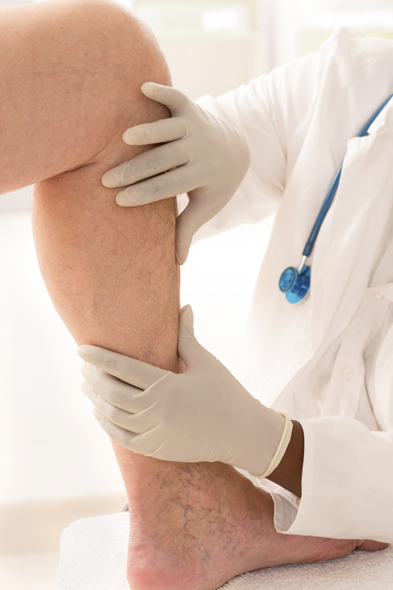 Vein Disease